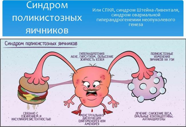 Синдром поликистозных яичников (спкя)