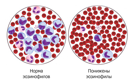 Миеломная болезнь диета