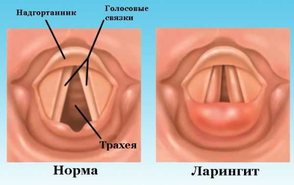 Ларингит - симптомы болезни, профилактика и лечение ларингита, причины заболевания и его диагностика на eurolab