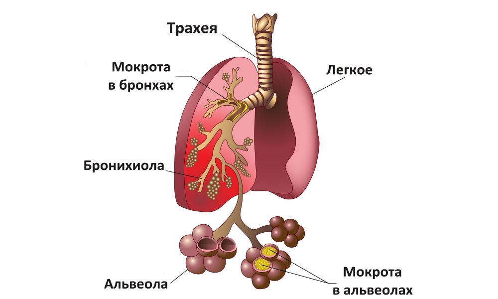 Виды бронхита, причины, симптомы, осложнения и методы лечения у взрослых