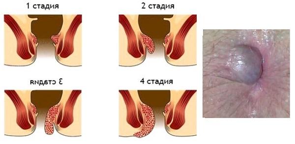 После того как сходил в туалет жжение. после дефекации возникает зуд в заднем проходе