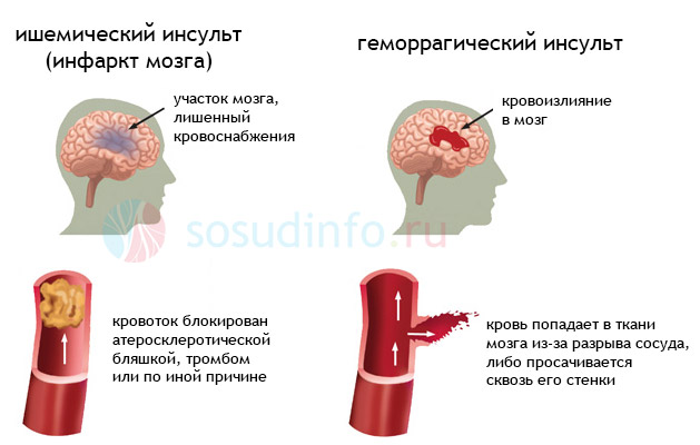 Причины, последствия и лечение нарушений кровообращения