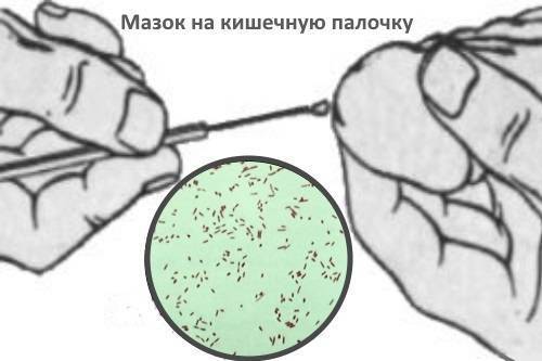 Кишечная палочка: чем опасна, как проявляется и как лечится
