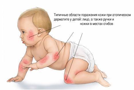 Как проявляется атопический дерматит у детей: симптомы и лечение