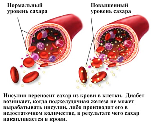 Глюкоза в крови