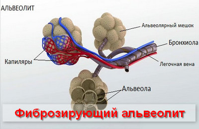 Идиопатический фиброзирующий альвеолит