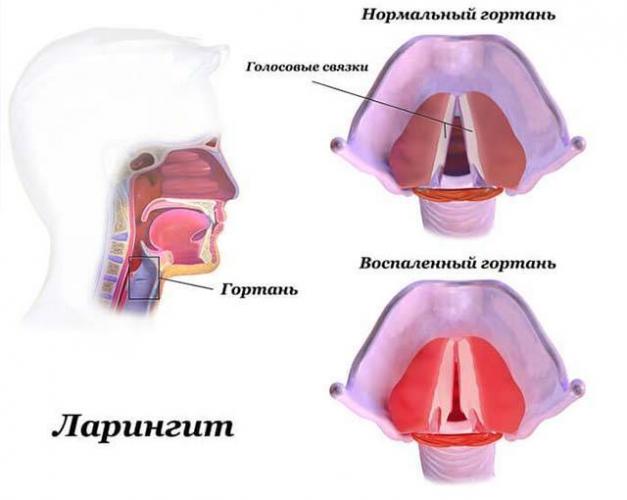 Симптомы отека горла и его лечение