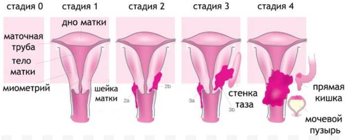 Стоит знать: что такое рак шейки матки и как его предотвратить — wonderzine
