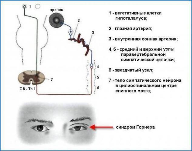 Причины миоза (суженных зрачков)