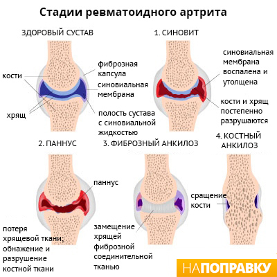 Ревматоидный артрит. причины, симптомы, диагностика