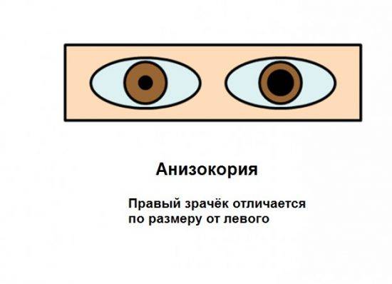 Расширен один зрачок?