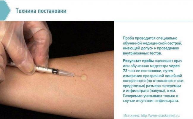 Реакция на диаскин тест