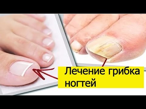 Как лечить паховую эпидермофитию: 14 шагов