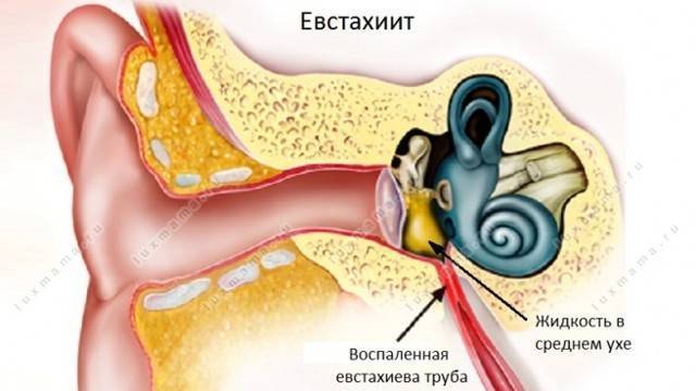Тубоотит: понятие, развитие, симптомы и лечение
