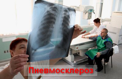 Пневмосклероз легких | eurolab | пульмонология