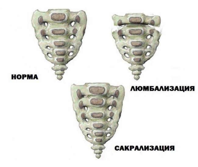 Позвоночник шестой поясничный позвонок