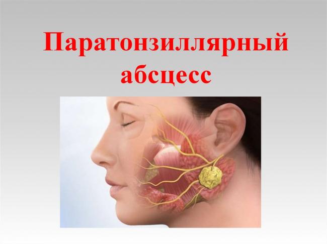 Паратонзиллярный абсцесс