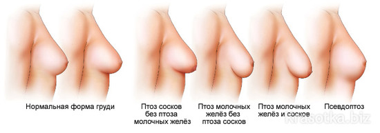 Птоз груди после лактации и кормления | mybreast.ru