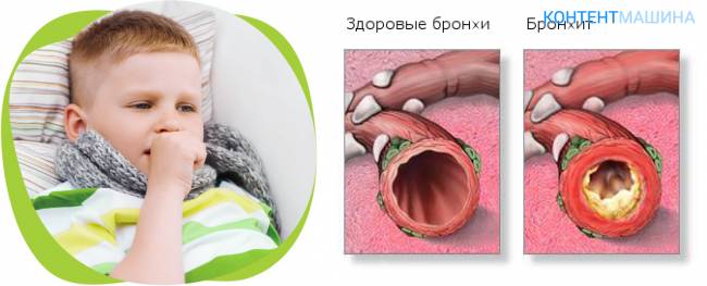 Кашель со свистом у взрослых, причины и лечение