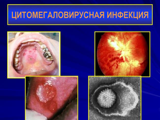 Возможные последствия цмв-инфекции — чем опасен цитомегаловирус