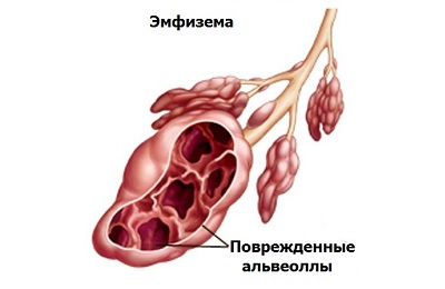 Облитерирующий бронхиолит
