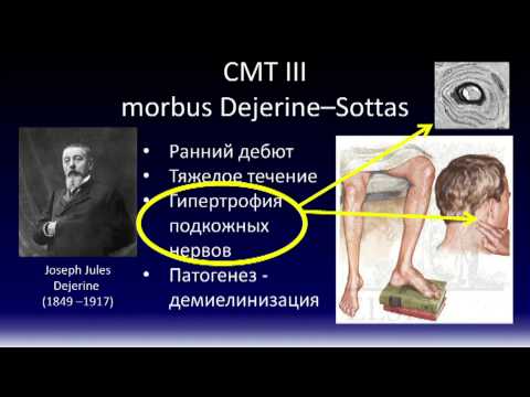 Болезнь шарко-мари-тута (шмт)