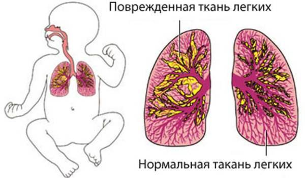 Пневмония у детей