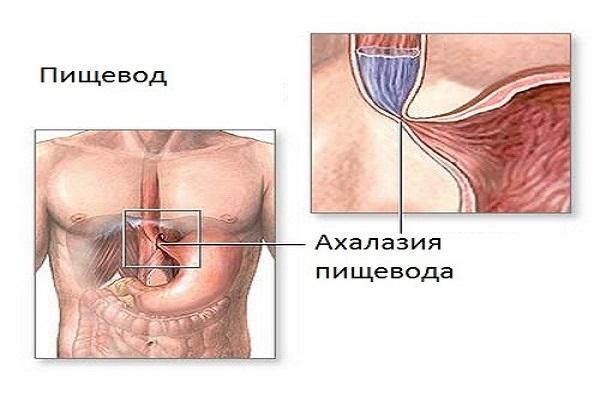 Ахалазия кардии пищевода