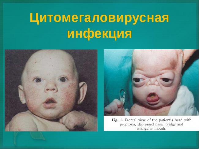 Цитомегаловирус: описание вируса и болезни