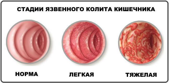 Сульфасалазин-ЕН Sulfasalazine-EN