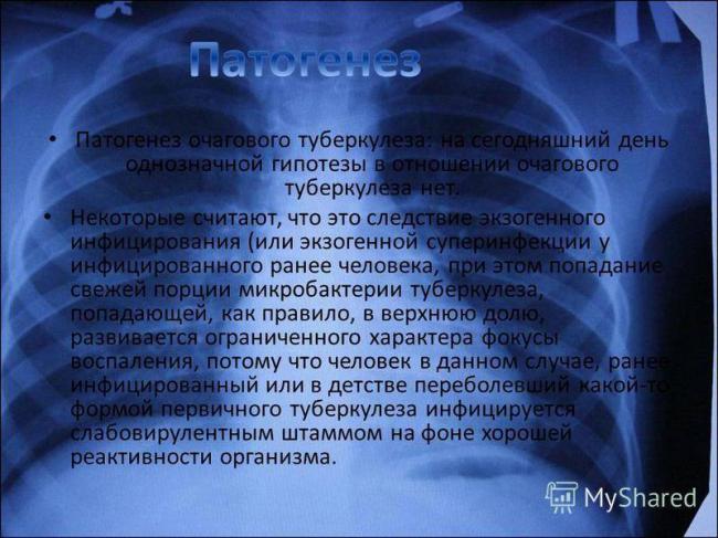 Инфильтративный туберкулез левого и правого легкого: лечение и дифференциальная диагностика