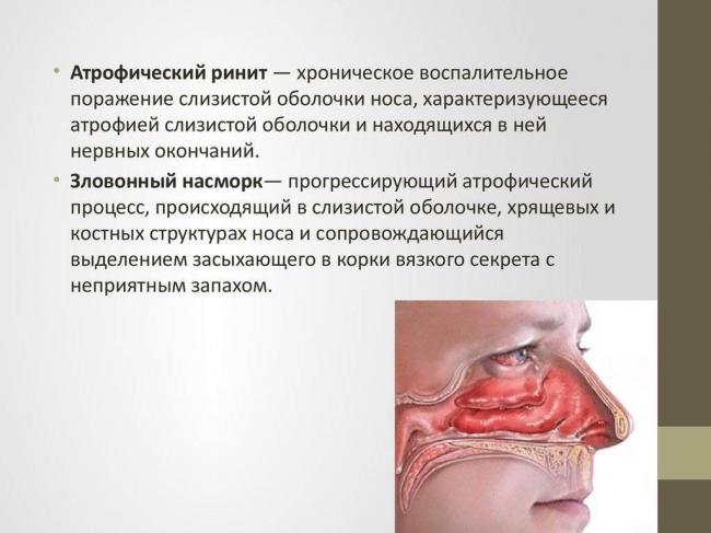 Атрофический ринит: лечение, что это такое, симптомы у взрослых и детей
