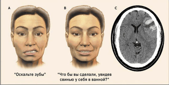 Парез лицевого нерва | симптомы | диагностика | лечение - docdoc.ru