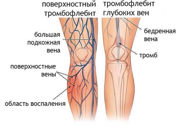 Осложнения на ноги у ребенка после орви