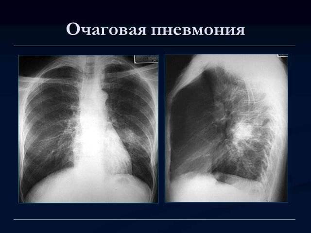 Признаки воспаления легких у взрослого