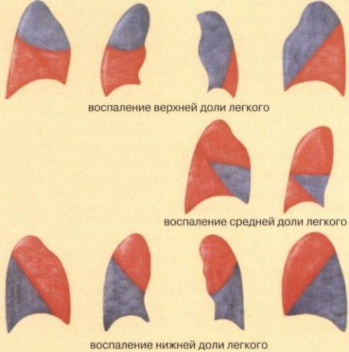 Антибактериальная терапия внебольничной пневмонии у детей