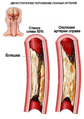 Окклюзия нижних конечностей