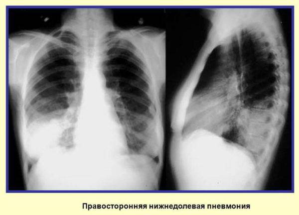 Описание и лечение правосторонней пневмонии у ребенка