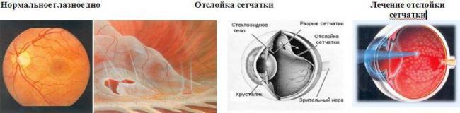 После замены хрусталика глаз видит мутно - причины и что делать
