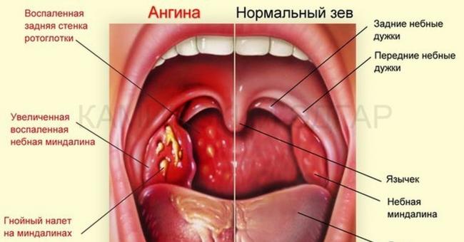 Болит горло с правой стороны при глотании с температурой и без