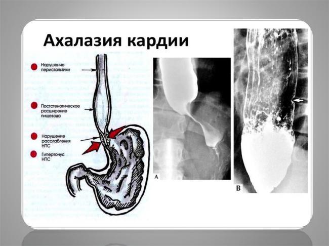 Причины, симптомы и лечение ахалазии пищевода