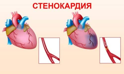 Нейпомакс