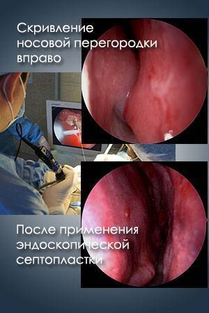 Пластическая операция на нос. виды, цены: коррекция перегородки, уменьшение носа, убрать горбинку, изменить форму, контурная ринопластика