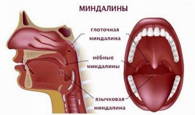 Хронический тонзиллит: методы лечения