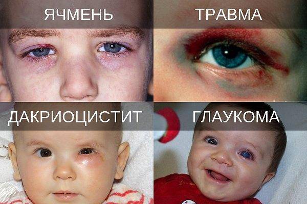 Красные нижние веки у ребенка
