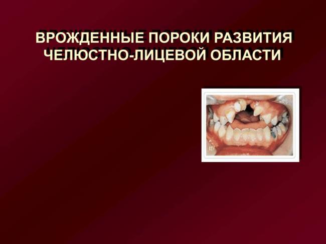 Заячья губа: причины возникновения