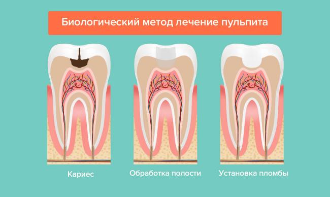 Лечение пульпита