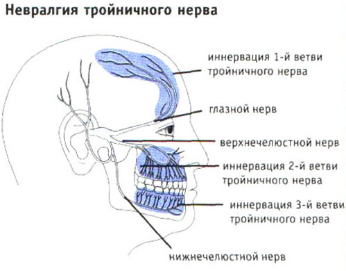 Воспаление тройничного нерва