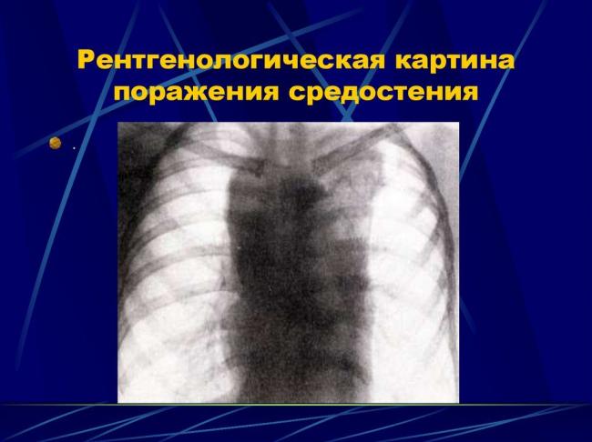 Лимфаденопатия по мкб 10