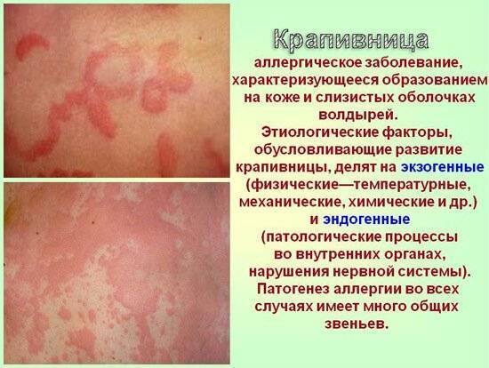 Холодовая аллергия. как определить и чем лечить?